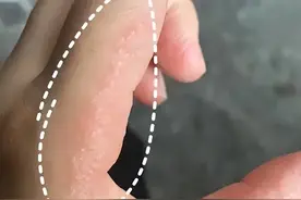 孩子老是手蜕皮只是干燥吗？还可能跟这三种疾病有关，可别大意图片