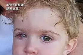 1岁多宝宝疑被大人亲吻后失明，医生：感染疱疹病毒致眼角膜穿孔 经历多次手术视力仍未恢复图片