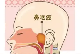 鼻咽癌，全文解析！图片