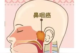 鼻咽癌，全文解析！图片