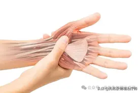 腱鞘炎是怎么产生的？该如何治疗?图片