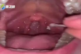 喉咙长出臭臭的“玉米粒”， 竟是因为……图片