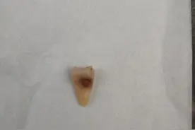掉牙齿图片