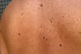身上长了3种斑点，可能和癌症有关，尽快检查，别当成了老年斑！图片