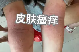 换季过敏、皮肤瘙痒怎么办？千万不要抓，3个止痒妙招立马见效！图片