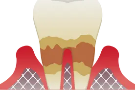 抓住了！让牙齿掉光的罪魁祸首！快看看你有没有？尽早这样做，让牙更稳固图片