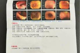 “活了30年才知道，这俩不是一个东西”！吃完15颗“小山楂”后，女子确诊胆汁反流性胃炎图片