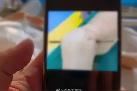 一男子从呼和浩特一工地三层铁架摔下，臀部被钢筋刺穿！图片