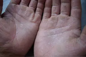 3招治好双手反复开裂！省钱又好操作！不允许有人还不知道！图片
