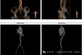 山西医科大学第一医院心脏大血管外科顺利完成两例高难度经导管主动脉瓣置换术（TAVR）图片