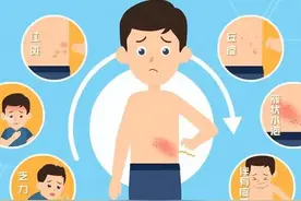 蛇缠腰：揭开带状疱疹的面纱图片