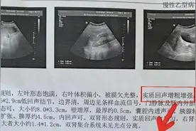希望所有肝病患者，彩超报告单都不出现这几种提示图片