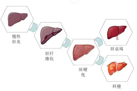 肝纤维化到肝硬化要多少年？肝纤维化能逆转吗？一文为你解答图片