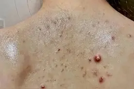 后背长痘痘是什么原因造成的？（附带保姆级祛痘攻略！）图片