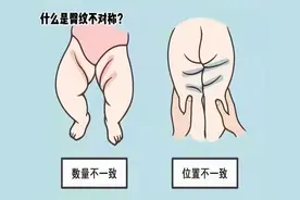 多关心，放“髋”心——关注DDH，让孩子走的更稳图片