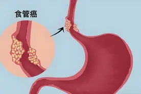 网友问：为什么很多患者发现食管癌就是晚期？图片