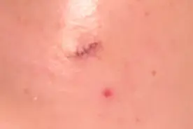 切痣留下了疤痕怎么办？图片