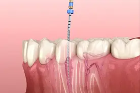 根管治疗真的有效吗？专家告诉你治疗后的长期效果与风险图片