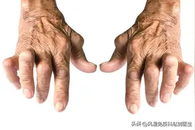 类风湿关节炎抗风湿，甲氨蝶呤、托法替布10种常用药你用对了吗？图片
