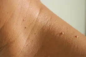 脖子和腋下的“小肉粒”是什么？能直接用手揪掉吗？告诉你答案图片