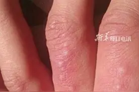 夏季易发"小水泡" 奇痒无比，医生:这是汗疱疹，日照出汗会复发，不可抓挠挤破,可这样处理……图片