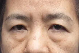 年龄上去，眼袋变大了？可能是身体出现了问题！图片
