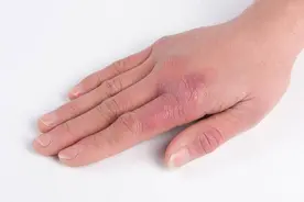 得了湿疹不要瞎折腾，鸡蛋加一种食材，湿疹可能得到很好的缓解！图片