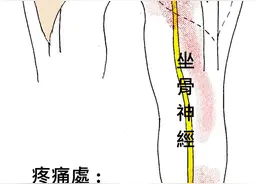 久坐族屁股痛，1颗球、3个动作缓解梨状肌综合征图片