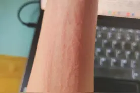 调理过敏体质脱敏，教您一招改善图片