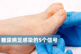 双脚有这5个表现，说明有糖尿病足感染！立即就医，千万不要拖到截肢图片
