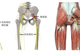 屁股（臀部）位置疼，腿麻木使不上力，可能是坐骨神经痛图片