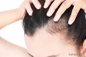 女性脱发6大原因，你是哪一种？图片