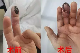 “黑化”了？男子吃完小龙虾差点截指！图片
