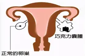 发现巧克力囊肿，要不要紧？要不要切？要注意什么？一文全解！图片