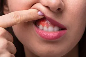 口腔溃疡、牙龈肿痛等四种口腔科常见病，建议试试中医自救法图片