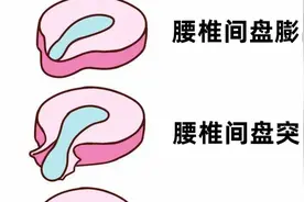 我现在才明白腰椎间盘突出症患者为什么有的睡觉也疼，翻身也疼了图片