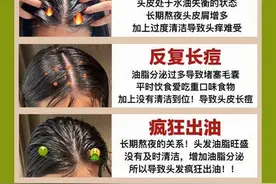 油性头屑多用什么洗发水??洗头膏去屑止痒推荐图片
