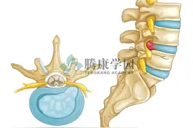 如何快速辨别椎间盘的膨出、突出、脱出、游离图片