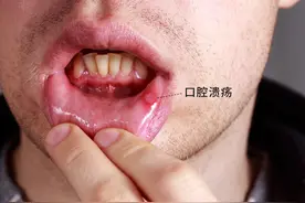 你以为的“上火”，或是癌症在敲门，出现5种症状，该做检查了图片