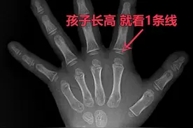 当检查孩子骨龄偏大，身高又偏矮，我们要想办法控制一下争取空间图片