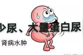 浅谈肾病综合征图片
