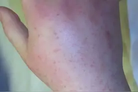 手背或胳膊上的红点红斑，是不是过敏性紫癜呢？图片