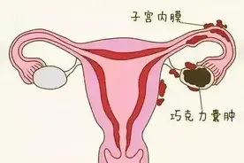 女性患有巧克力囊肿，会影响怀孕吗？图片