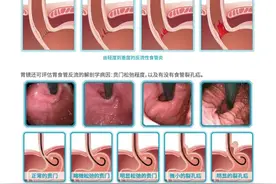 为啥这种检测被称为胃食管反流病检查的“金标准”？图片