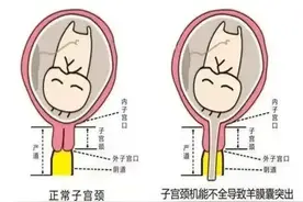 二胎妈妈22周宫口全开险流产！医生提醒，这6个信号必须警惕！图片