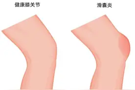 膝盖疼痛，骨关节炎还是滑囊炎，哪个更痛苦？图片