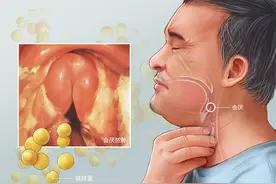 警惕！近期高发的嗓子疼可能是“凶险”急症的征兆！图片