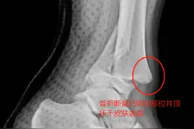 13岁少年打篮球一个起跳脚踝骨折，医生：运动前充分热身很有必要图片