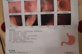 上腹部不适和胃部不适，进行胃镜检查时，我经历了什么？图片