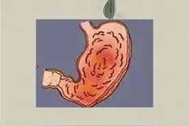 6种胃病看看你是哪一种图片